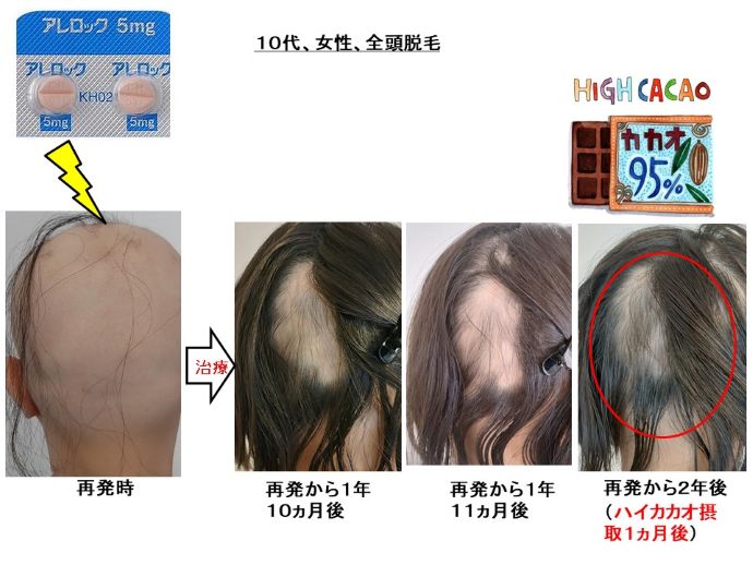 円形脱毛症　病院